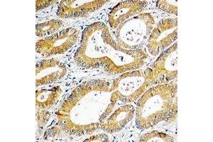 Immunohistochemical analysis of SGK1 staining in human colon cancer formalin fixed paraffin embedded tissue section. (SGK1 Antikörper  (C-Term))