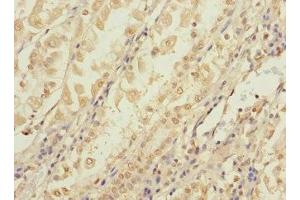 Immunohistochemistry of paraffin-embedded human gastric cancer using ABIN7148092 at dilution of 1:100 (CCDC15 Antikörper  (AA 1-245))