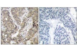 Immunohistochemical analysis of paraffin-embedded human breast carcinoma tissue, using β-Catenin (Ab-37) antibody (E021212). (beta Catenin Antikörper)