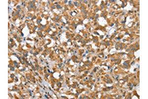 The image on the left is immunohistochemistry of paraffin-embedded Human thyroid cancer tissue using ABIN7190368(CSMD1 Antibody) at dilution 1/40, on the right is treated with synthetic peptide.