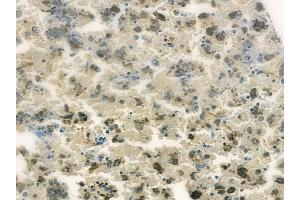 ABIN6260356 and ABIN6278190 at 1/100 staining human melanoma by IHC-P. (BORA Antikörper  (C-Term))