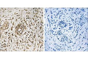 Peptide - +Immunohistochemistry analysis of paraffin-embedded human breast carcinoma tissue, using CIB2 antibody. (CIB2 Antikörper  (Internal Region))