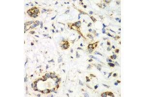 Immunohistochemistry of paraffin-embedded human liver cancer using NRBF2 antibody (ABIN6290681) at dilution of 1:100 (40x lens). (NRBF2 Antikörper)