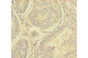 Immunohistochemistry of paraffin-embedded human endometrial cancer using ABIN7160909 at dilution of 1:100 (NDUFA6 Antikörper  (AA 27-154))
