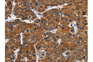 The image on the left is immunohistochemistry of paraffin-embedded Human liver cancer tissue using ABIN7128793(CATSPER3 Antibody) at dilution 1/60, on the right is treated with fusion protein.
