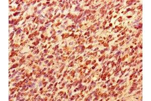 Immunohistochemistry of paraffin-embedded human glioma using ABIN7172435 at dilution of 1:100