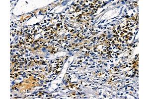 ABIN7094959 and ABIN7099015 at 1/100 staining human esophageal cancer by IHC-P. (PAXIP1 Antikörper)