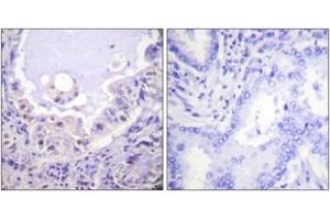 Immunohistochemistry analysis of paraffin-embedded human lung carcinoma tissue, using C-RAF (Ab-621) Antibody. (RAF1 Antikörper  (AA 591-640))