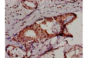 IHC image of ABIN7156261 diluted at 1:500 and staining in paraffin-embedded human breast cancer performed on a Leica BondTM system. (IKBKB Antikörper  (AA 395-588))