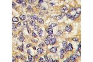 IHC analysis of FFPE human breast carcinoma tissue stained with UCHL3 antibody