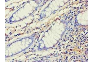 Immunohistochemistry of paraffin-embedded human colon cancer using ABIN7143993 at dilution of 1:100 (AES Antikörper  (N-Term))
