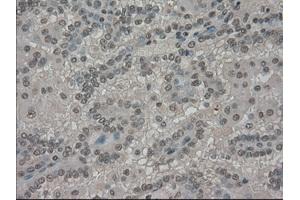 Immunohistochemical staining of paraffin-embedded Carcinoma of kidney tissue using anti-SLC7A8mouse monoclonal antibody.