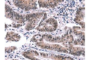 The image on the left is immunohistochemistry of paraffin-embedded Human colon cancer tissue using ABIN7191561(MYF5 Antibody) at dilution 1/15, on the right is treated with synthetic peptide. (MYF5 Antikörper)