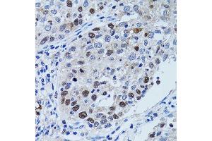 Immunohistochemistry of paraffin-embedded human lung cancer using UHRF1 antibody.