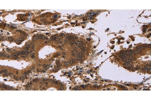 Immunohistochemistry of paraffin-embedded Human colon cancer using EDN2 Polyclonal Antibody at dilution of 1:30 (Endothelin 2 Antikörper)