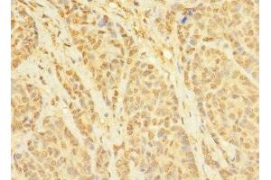Immunohistochemistry of paraffin-embedded human ovarian cancer using ABIN7171721 at dilution of 1:100 (CCDC79 Antikörper  (AA 301-550))