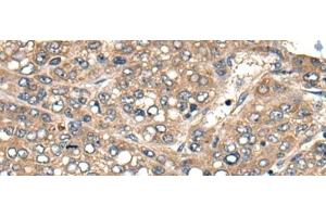 Immunohistochemistry of paraffin-embedded Human liver cancer tissue using ACER1 Polyclonal Antibody at dilution of 1:50(x200) (ACER1 Antikörper)