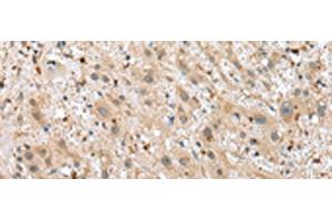 Immunohistochemistry of paraffin-embedded Human liver cancer tissue using TPPP Polyclonal Antibody at dilution of 1:25(x200) (Tppp Antikörper)