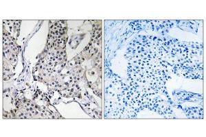 Immunohistochemistry analysis of paraffin-embedded human breast carcinoma tissue using PHLDA3 antibody. (PHLDA3 Antikörper  (Internal Region))