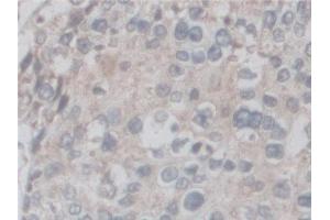 Detection of CF6 in Human Prostate cancer Tissue using Polyclonal Antibody to Coupling Factor 6 (CF6)