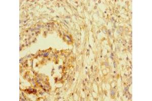 Immunohistochemistry of paraffin-embedded human pancreatic cancer using ABIN7172767 at dilution of 1:100 (ATRX Antikörper  (AA 2161-2443))