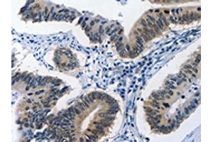 The image on the left is immunohistochemistry of paraffin-embedded Human colon cancer tissue using ABIN7190002(BPIFB1 Antibody) at dilution 1/40, on the right is treated with synthetic peptide. (BPIFB1 Antikörper)
