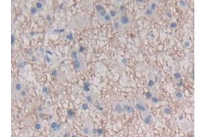 DAB staining on IHC-P; Samples: Human Glioma Tissue (IFNE Antikörper  (AA 30-208))