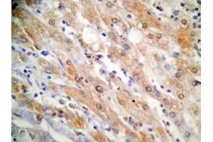 Human hepatocellular carcinoma tissue was stained by Rabbit Anti-FGF-21 (26-47) (H) Antibody (FGF21 Antikörper  (AA 26-47))