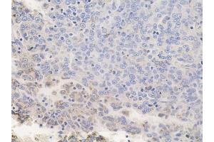 ABIN6256798 and ABIN6267346 at 1/100 staining human melanoma by IHC-P. (PDGFRB Antikörper  (pTyr771))