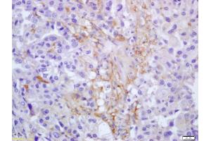 Formalin-fixed and paraffin embedded human lung carcinoma labeled with Anti-CLEC2/CLEC1B Polyclonal Antibody, Unconjugated (ABIN741810) at 1:200 followed by conjugation to the secondary antibody and DAB staining (C-Type Lectin Domain Family 1, Member B (CLEC1B) (AA 1-100) Antikörper)