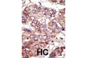 Formalin-fixed and paraffin-embedded human cancer tissue reacted with the primary antibody, which was peroxidase-conjugated to the secondary antibody, followed by AEC staining. (ACSL6 Antikörper  (AA 240-270))