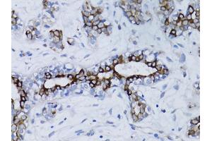 Immunohistochemistry of paraffin-embedded human breast cancer using BRCA1 antibody. (BRCA1 Antikörper)