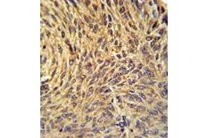 Immunohistochemistry analysis in formalin fixed and paraffin embedded human lung carcinoma reacted with NUP210 / GP210 Antibody (N-term) followed by peroxidase conjugation of the secondary antibody and DAB staining. (NUP210 Antikörper  (N-Term))