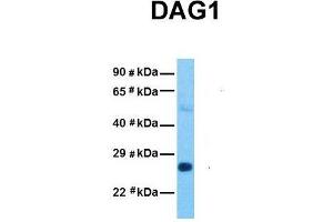 Host:  Rabbit  Target Name:  DAG1  Sample Tissue:  Human Stomach Tumor  Antibody Dilution:  1. (Dystroglycan Antikörper  (Middle Region))