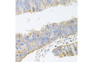 Immunohistochemistry of paraffin-embedded human colon carcinoma using GP2 antibody at dilution of 1:100 (x40 lens). (GP2 Antikörper)