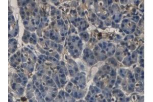 Detection of RNASE3 in Human Pancreatic cancer Tissue using Monoclonal Antibody to Ribonuclease A3 (RNASE3) (RNASE3 Antikörper  (AA 30-154))