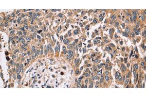 Immunohistochemistry of paraffin-embedded Human lung cancer using FUCA1 Polyclonal Antibody at dilution of 1:30 (FUCA1 Antikörper)