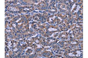 The image on the left is immunohistochemistry of paraffin-embedded Human thyroid cancer tissue using ABIN7191187(KCNJ9 Antibody) at dilution 1/30, on the right is treated with synthetic peptide. (KCNJ9 Antikörper)