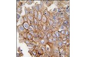 Formalin-fixed and paraffin-embedded human lung carcinoma tissue reacted with ANXA2 antibody (C-term), which was peroxidase-conjugated to the secondary antibody, followed by DAB staining.