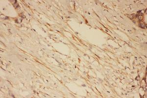 Anti-PSD95 antibody, IHC(P) IHC(P): Human Intestinal Cancer Tissue