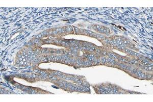 ABIN6278876 at 1/100 staining Human cervical cancer tissue by IHC-P. (IFIT2 Antikörper  (Internal Region))