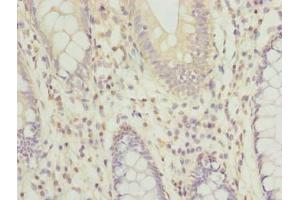 Immunohistochemistry of paraffin-embedded human colon cancer using ABIN7167582 at dilution of 1:100 (RPRD1B Antikörper  (AA 2-172))