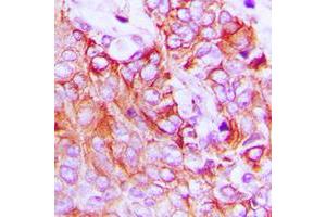 Immunohistochemical analysis of HER4 staining in human breast cancer formalin fixed paraffin embedded tissue section.