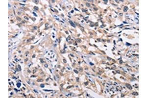 The image on the left is immunohistochemistry of paraffin-embedded Human esophagus cancer tissue using ABIN7128359(ALG8 Antibody) at dilution 1/30, on the right is treated with fusion protein. (ALG8 Antikörper)