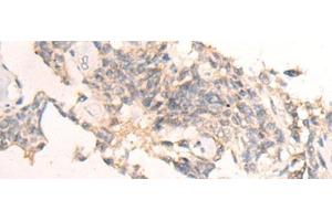 Immunohistochemistry of paraffin-embedded Human ovarian cancer tissue using IBA57 Polyclonal Antibody at dilution of 1:65(x200) (IBA57 Antikörper)