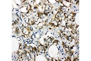 IHC-P: Cytokeratin 8 antibody testing of human breast cancer tissue (KRT8 Antikörper  (N-Term))