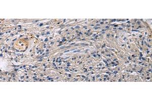 Immunohistochemistry of paraffin-embedded Human brain tissue using SLC30A3 Polyclonal Antibody at dilution of 1:55(x200) (Slc30a3 Antikörper)