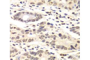 Immunohistochemistry of paraffin-embedded Human colon carcinoma using CCNC Polyclonal Antibody at dilution of 1:100 (40x lens). (Cyclin C Antikörper)