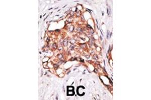 Formalin-fixed and paraffin-embedded human cancer tissue reacted with the primary antibody, which was peroxidase-conjugated to the secondary antibody, followed by DAB staining. (GDF3 Antikörper  (N-Term))