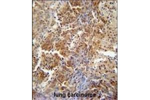 ERCC8 antibody (Center) (ABIN654909 and ABIN2844556) immunohistochemistry analysis in formalin fixed and paraffin embedded human lung carcinoma followed by peroxidase conjugation of the secondary antibody and DAB staining. (ERCC8 Antikörper  (AA 210-238))